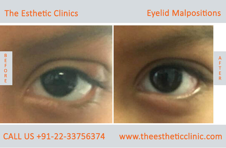 Eyelid Malpostions, Ectropion Entropion Surgery before after photos in mumbai india (6)